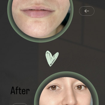 Контурна пластика губ
                    Врач-косметолог Ирина Краматорск