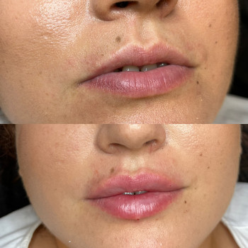 Контурна пластика губ
                    Врач-косметолог Ирина Краматорск