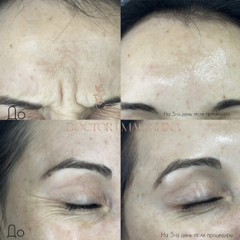 Ботокс
                    Врач-косметолог Ирина Краматорск