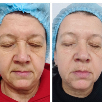 Фракційний рф-ліфтинг - клієнтка 62 роки до та після курсу з 3 процедур   