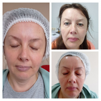 Фракціний rfліфтинг до (верхнє фото справа), після 1 процедури (нижнє фото справа) та після 2 процед...