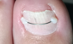 Встановлення титанової нитки, корекційної системи Майстер манікюру Вікторія Кам'янське