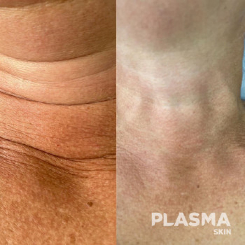 Усунення вікових змін і омолодження шкіри в зоні шиї, фото - Косметологический центр Plasmaskin Cosmetology