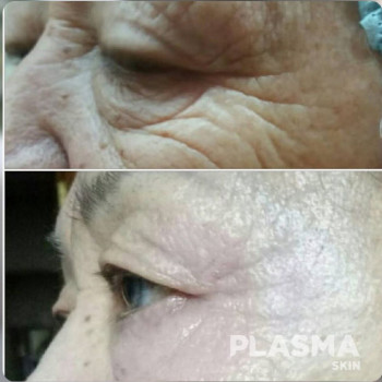 Удаление глубоких морщин с помощью холодной плазмы. Подтяжка век