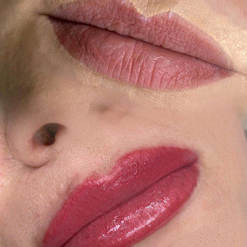 До/після процедури