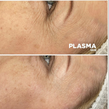 Апаратне омолодження "Плазмовий душ"
                    Косметологический центр Plasma Skin Cosmetology Харьков