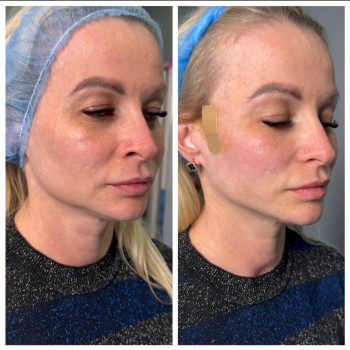 Подтяжки лица нитями с насечками Cog, Molding
                    Косметолог-инъекционист Наталья Днепр