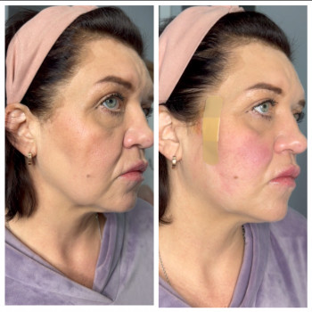 Подтяжки лица нитями с насечками Cog, Molding
                    Косметолог-инъекционист Наталья Днепр