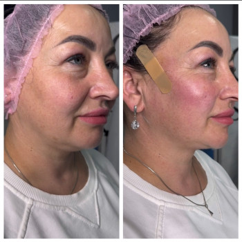 Подтяжки лица нитями с насечками Cog, Molding
                    Косметолог-инъекционист Наталья Днепр