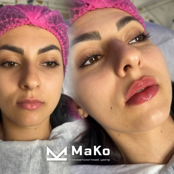 Аугментація губ
    