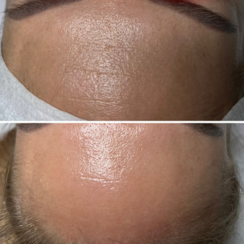 Процедура «лід та вогонь» 
IS CLINICAL