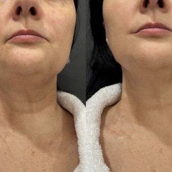 RF-ліфтинг - апаратне омолодження.
   