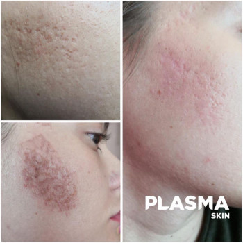 Результат удаления рубцов от акне методом сублимации холодной плазмой