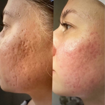 Сублимация+микроплазменный термолиз