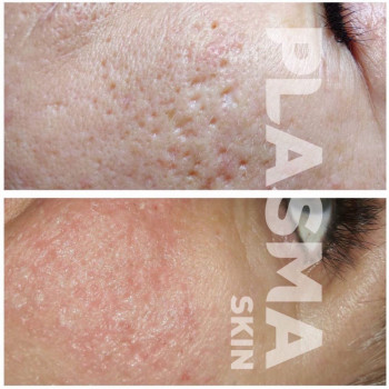 сублимация постакне (2 пр-ра)