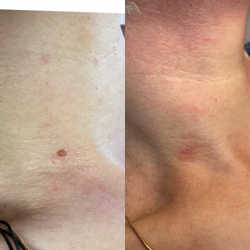 Видалення папілом.