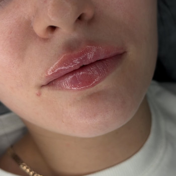 Контурна пластика губ
                    Врач-косметолог Ирина Краматорск