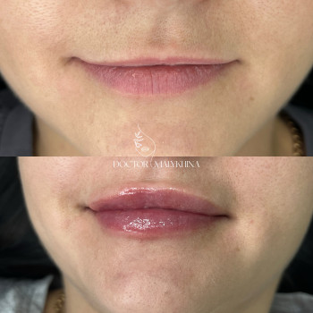Контурна пластика губ
                    Врач-косметолог Ирина Краматорск