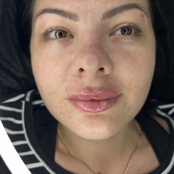 Контурна пластика губ
                    Врач-косметолог Ирина Краматорск