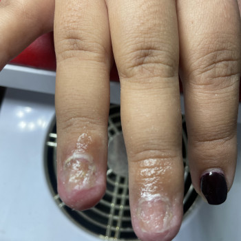 Лікування хімічного опіку