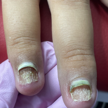 Хімічний опік, бактеріальна інфекція