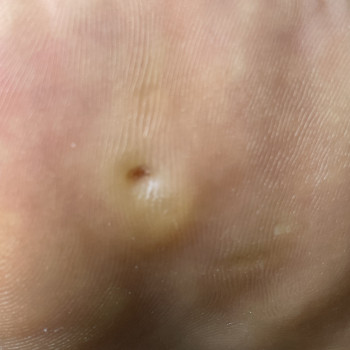 Стрижневий мозоль