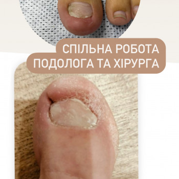 Травма нігтя, екзостоз