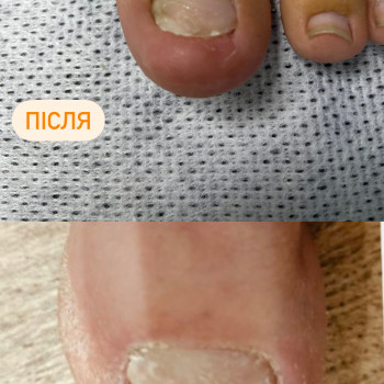 Відновлення нігтя після операційного втручання.