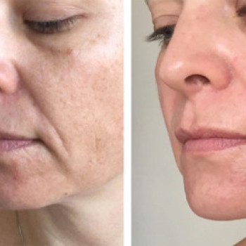 Результат після курсу масажа обличчя