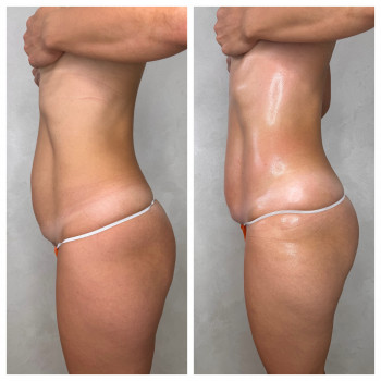 Lipokiller
                    Массажист Елена Одесса