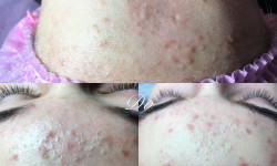 Карбоксітерапія Medicare Косметологический центр Perfect Skin Киев