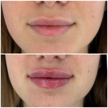 Збільшення губ