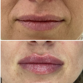 Збільшення губ