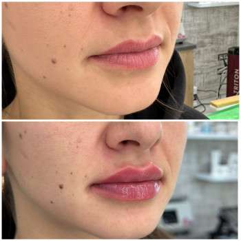 Контурна пластика губ