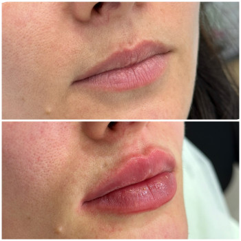 Контурна пластика губ