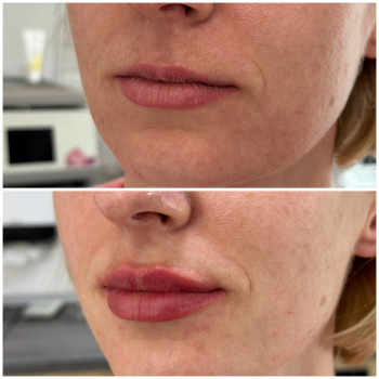 Контурна пластика губ