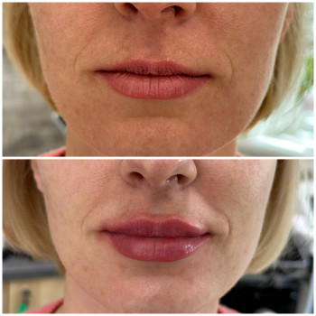 Контурна пластика губ