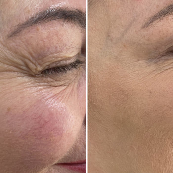 Ботулінотерапія