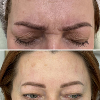 Ботулінотерапія