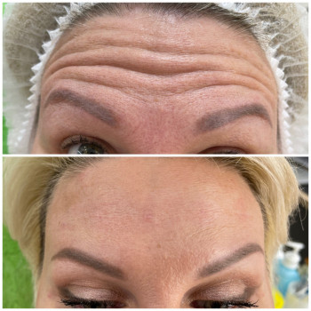 Ботулінотерапія