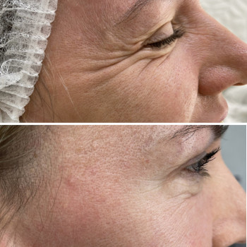 Ботулінотерапія