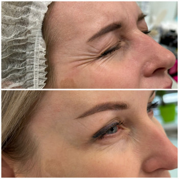 Ботулінотерапія