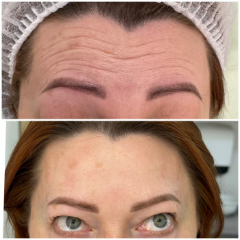 Ботулінотерапія