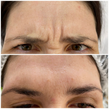 Ботулінотерапія