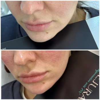 Контурна пластика обличчя