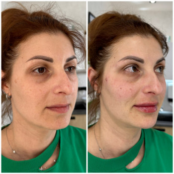 Контурна пластика обличчя