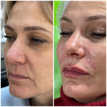 Контурна пластика обличчя