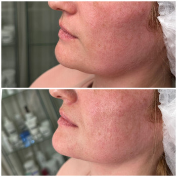 Контурна пластика обличчя