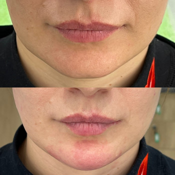 Контурна пластика обличчя