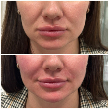 Контурна пластика обличчя